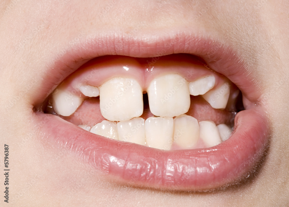 Naklejka premium Young Boy's Teeth Closeup