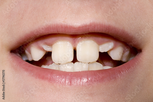 Young Boy's Teeth Closeup