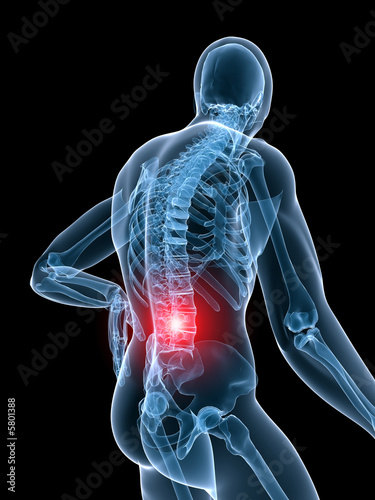 röntgen illustration-rückenschmerzen
