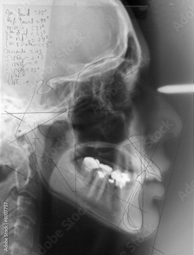 Radiographie dentaire photo