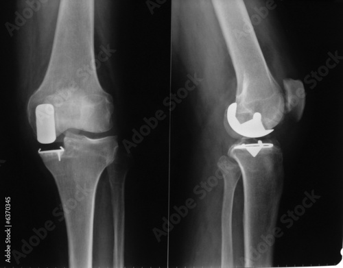 prothése unicompartimentale de genou photo