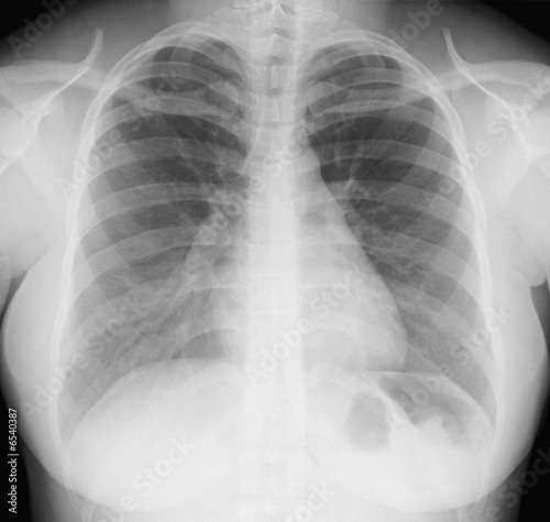 Radiographie thorax de face