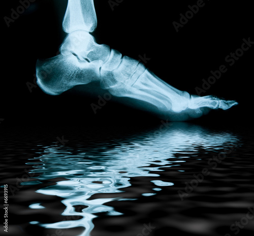 Radiografia del piede con riflesso