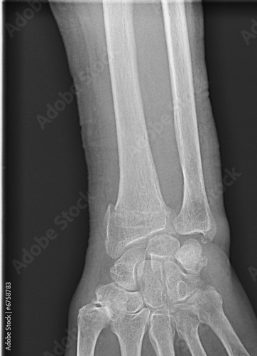 Radiographie fracture du radius
