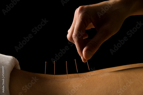 Acupuncture