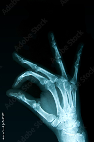Radiografia della mano