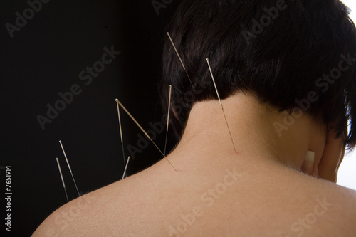 Acupuncture needles on back of a young woman