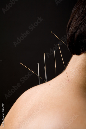Acupuncture needles on back of a young woman