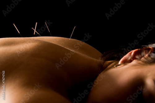 Acupuncture photo