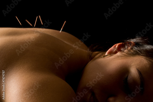 Acupuncture