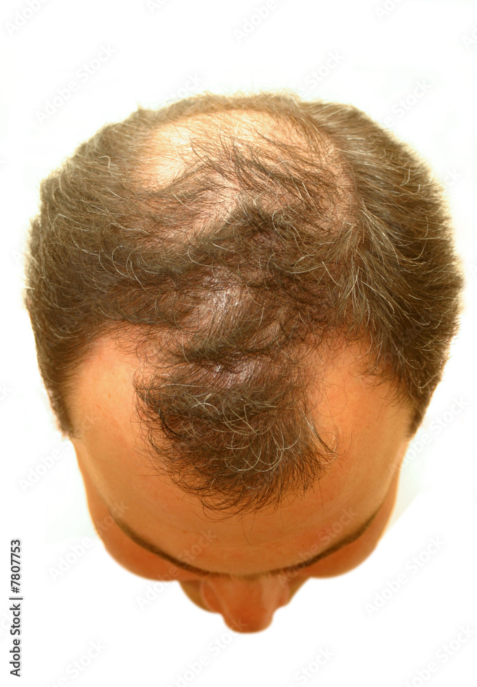 Obraz premium male head with hair loss symptoms
