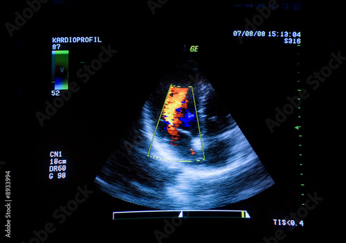 Heart ultrasound image on computer screen. photo