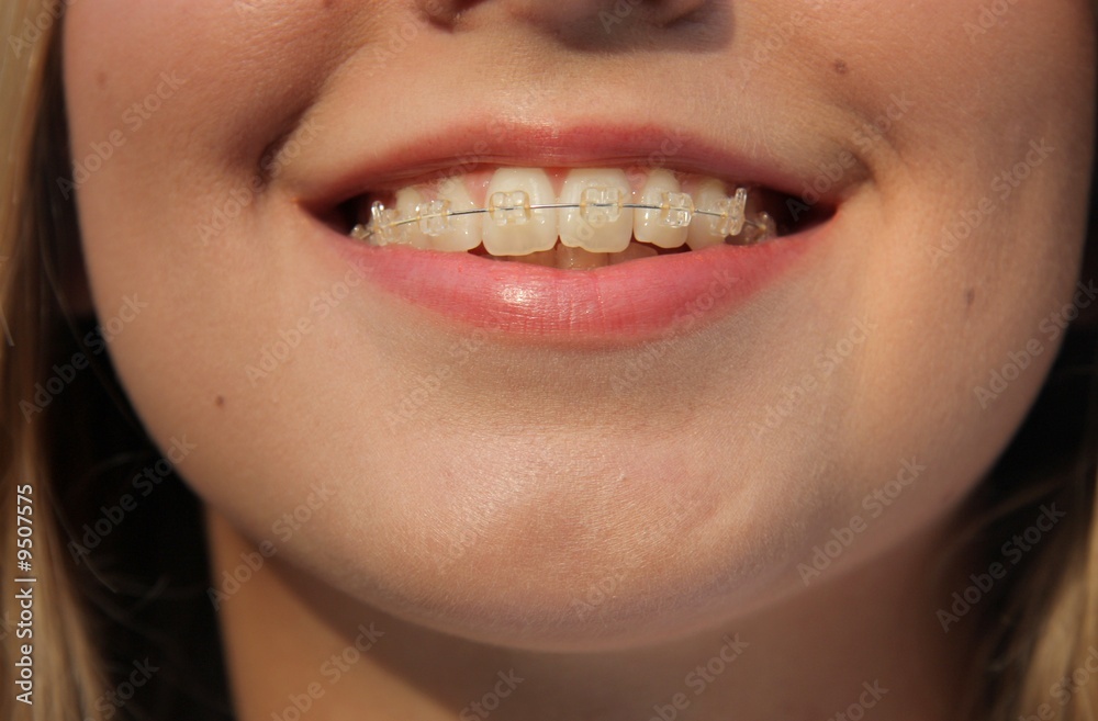 brace StockFoto Adobe Stock