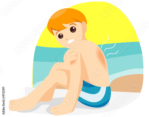 Sunburn