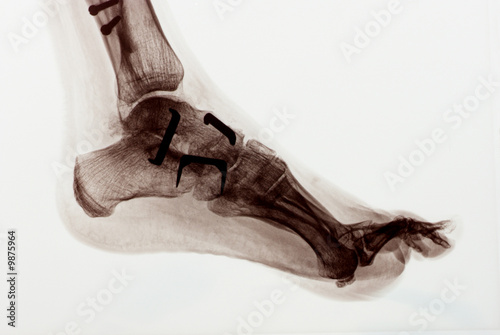 radiography of a foot