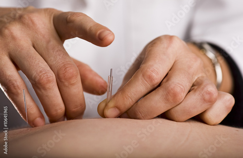 Tapping in acupuncture needle photo