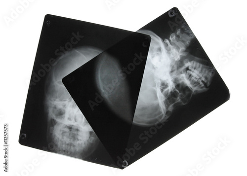 black and white photo of x-ray pictures of human skulls