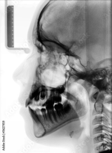 X-ray picture of the skull