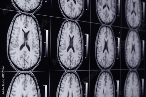 MRI Gehirn