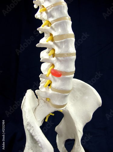 Bandscheibenvorfall - Darstellung an Wirbelsäule