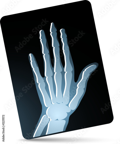 X-ray photo of hand