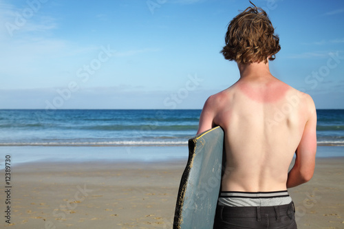 The sunburnt surfer.