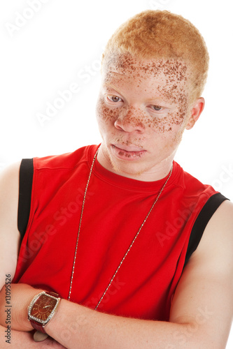 Photos Albino Man