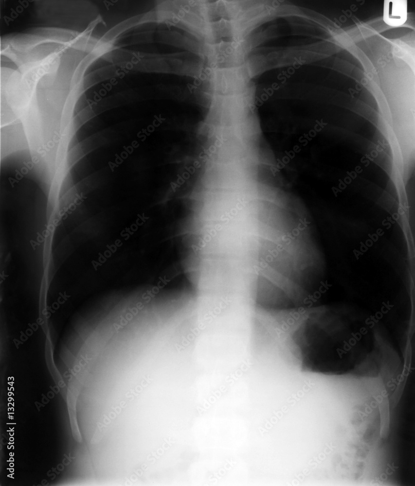 Chest x-ray