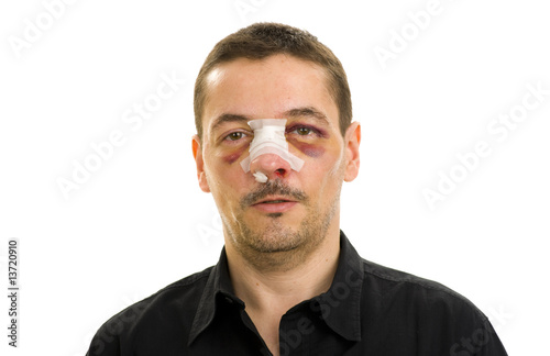 broken nose and black eyes post operation