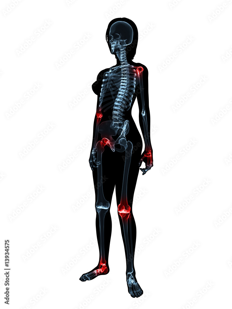 weibliches skelett mit schmerzenden gelenken
