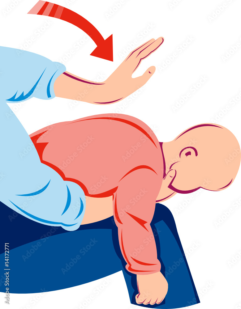Adult performing Heimlich maneuver on infant Adult performing Heimlich maneuver on infant
