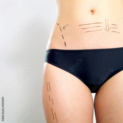 Plastic surgery patient's abdomen and thigh