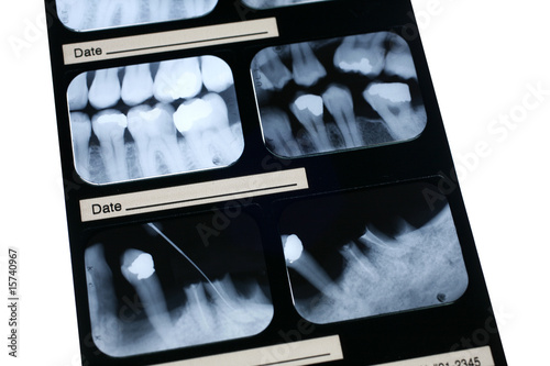 Dental X-ray
