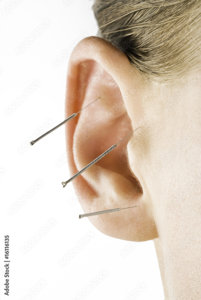 Akupunktur StockFoto Adobe Stock