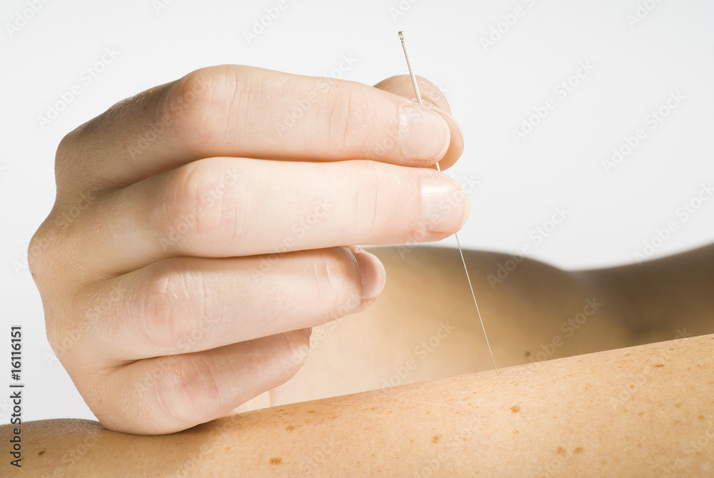 Akupunktur StockFoto Adobe Stock