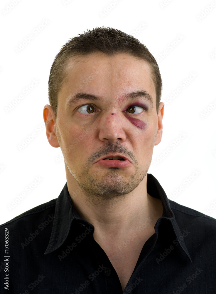 broken, crooked nose and black, crossed eyes broken, crooked nose and black, crossed eyes