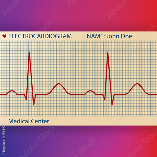 Electrocardiogram Paper with Normal ECG Graphic Line