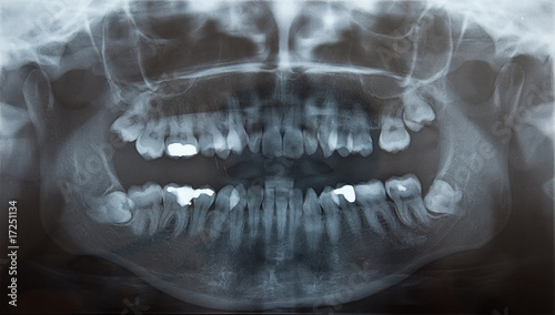 X-Ray of problematic wisdom teeth for extraction