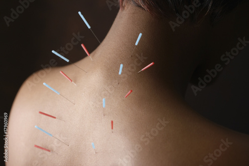 Acupuncture needles in African woman's back