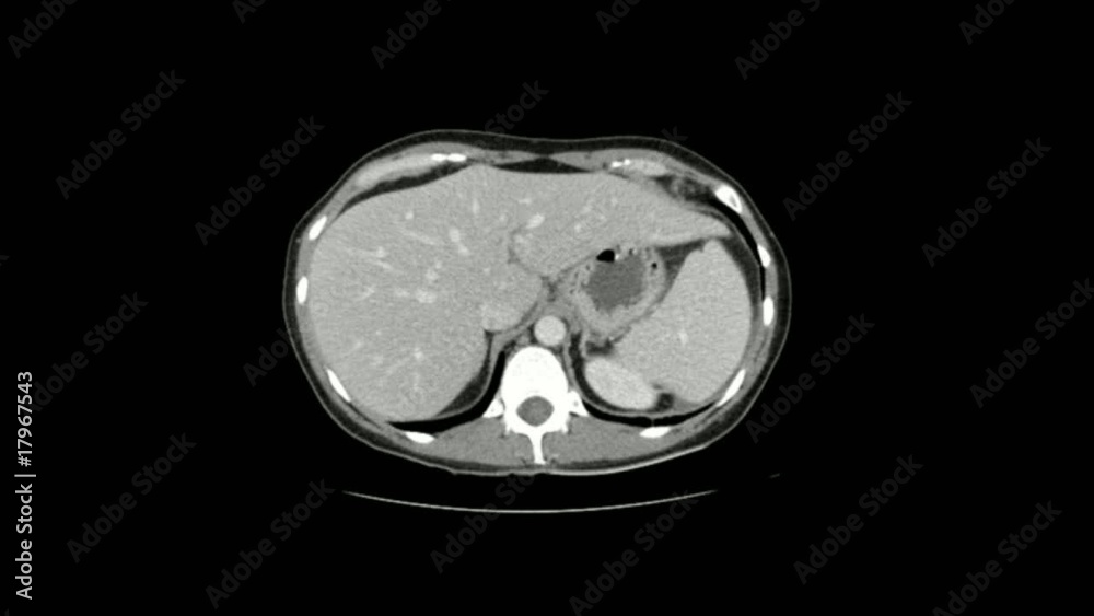 ct scan abdominal and pelvis ct scan abdominal and pelvis