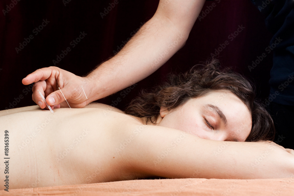 Fototapeta premium Chinese doctor performing acupuncture on a young woman
