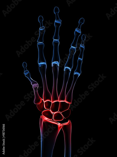 menschliches Handskelett mit Arthritis