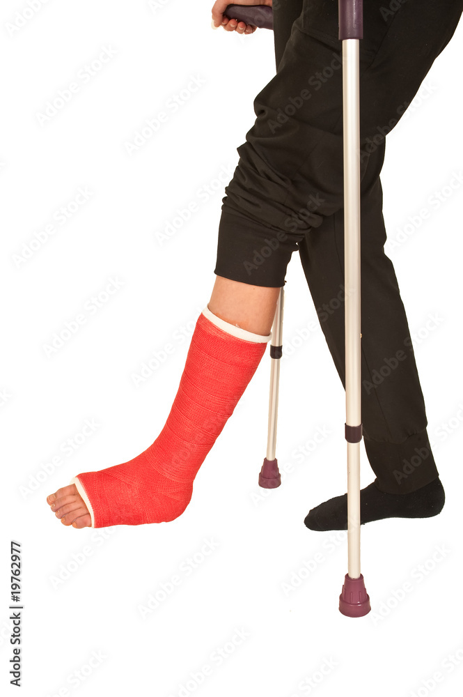 Gipsbein und Krücken Stock Photo | Adobe Stock