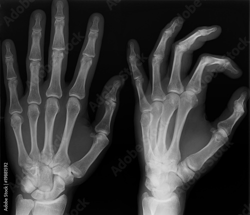 Left hand x-ray shoot in two versions.