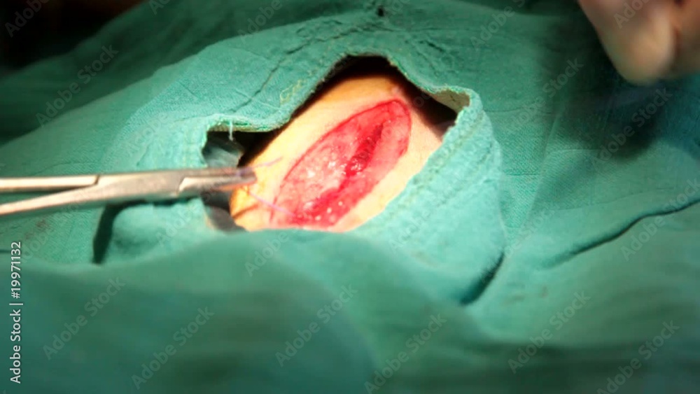 points de suture internes