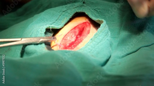 points de suture internes