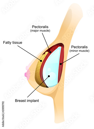Breast implant diagram