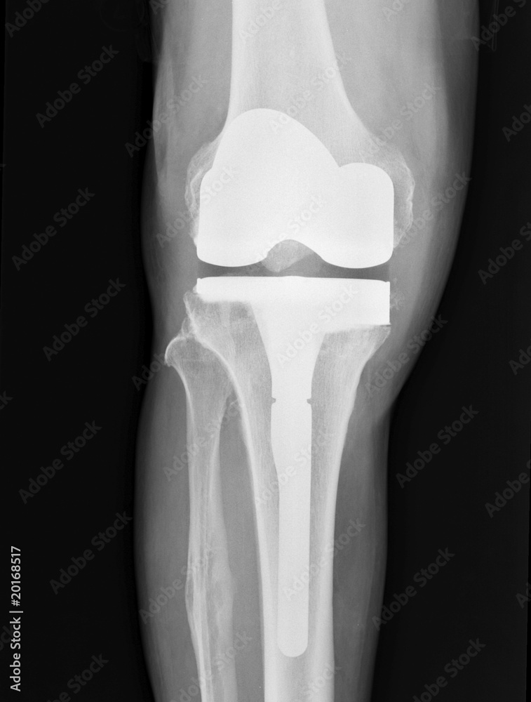 Artificial Knee xray of total knee arthroplasty Stock Photo Adobe Stock