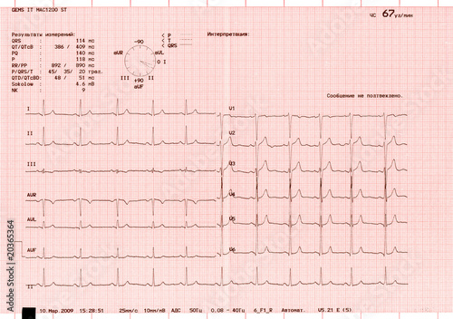 The graphs of an electrocardiogram