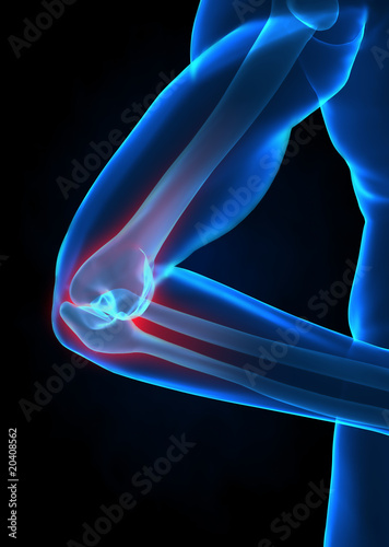 Canvas Print X-ray elbow pain concept